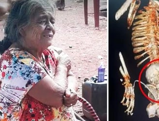 Daniela Almeida Vera, de 81 años, presentó la extraña condición de litopedia. Foto: composición LR/Globo